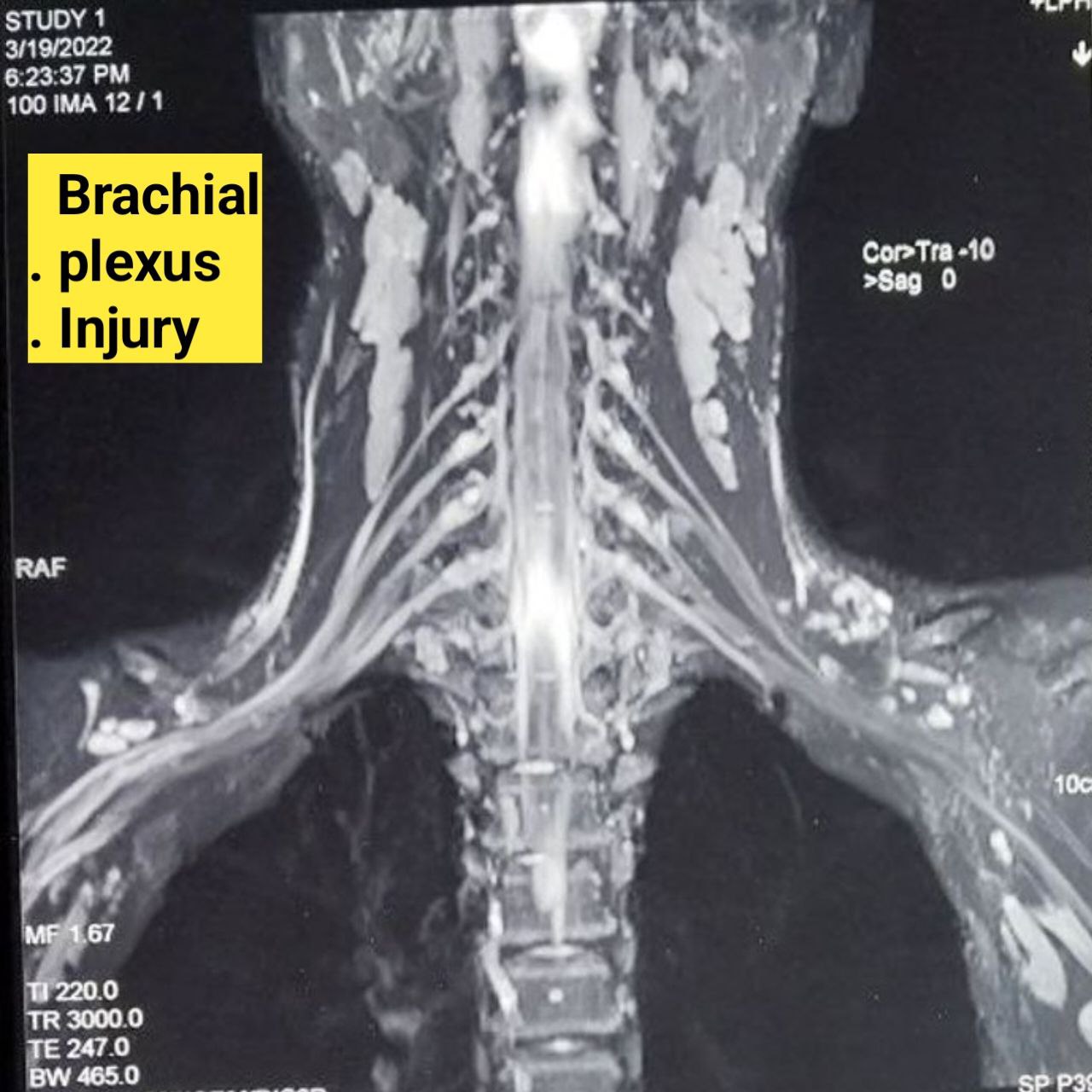 Brachial plexus injury