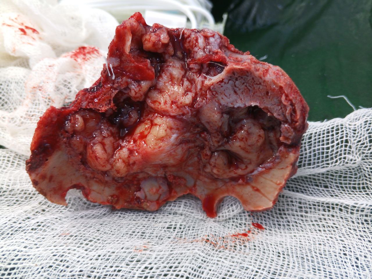 ক্যানসার কি? ক্যানসার থেকে বাঁচার উপায় কি?