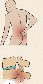 5 symptoms indicates surgical intervention in PLID